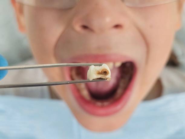 Best Emergency Tooth Extraction in Greenhills, OH